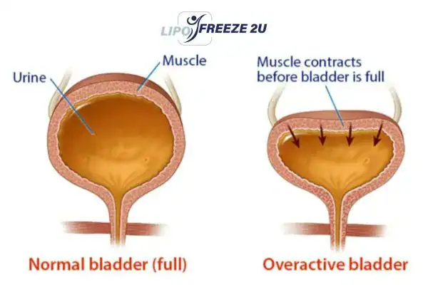 diagram of overactive bladder treatment Sandwich