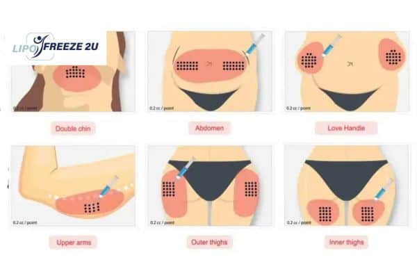 Benefits of Choosing Aqualyx for Fat Reduction Sandwich