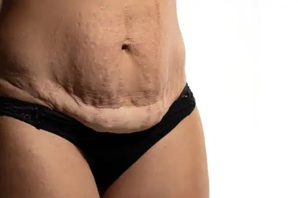 loose skin after weight loss injections Sandwich