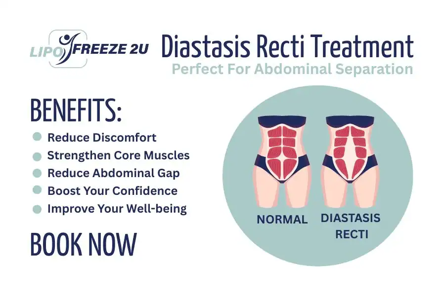 How Long Will It Take to See Improvements in Diastasis Recti Sandwich