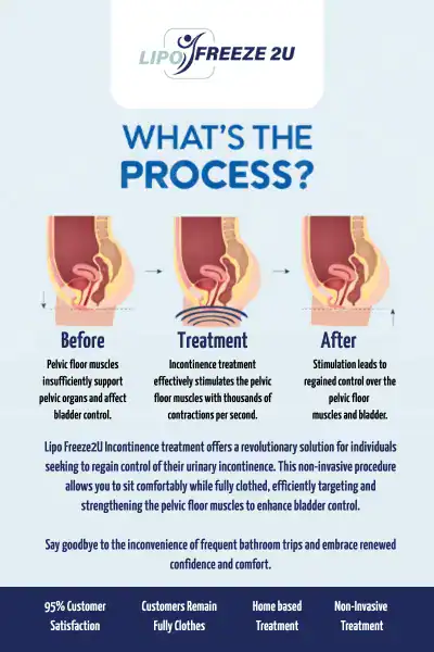 Diagram of how incontinence treatment Sandwich works.