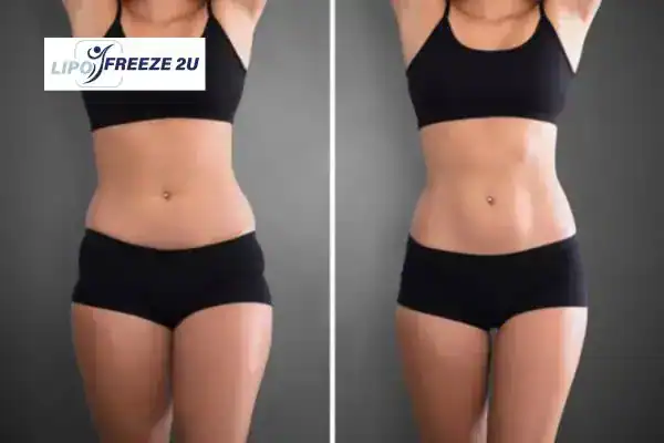 How Can LIPO FREEZE 2U Support Your Post-Pregnancy Body Recovery Sandwich?