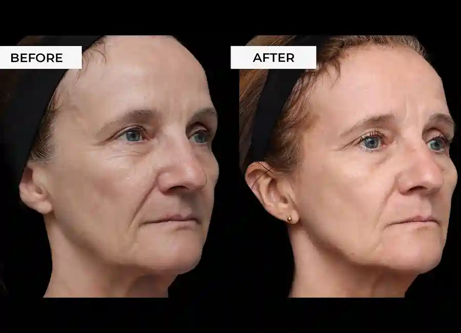 How Many RF Microneedling Sessions Will You Need to See a Difference Sandwich?