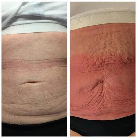 How Does RF Microneedling Improve Crepey, Thin and Uneven Skin Texture Sandwich?