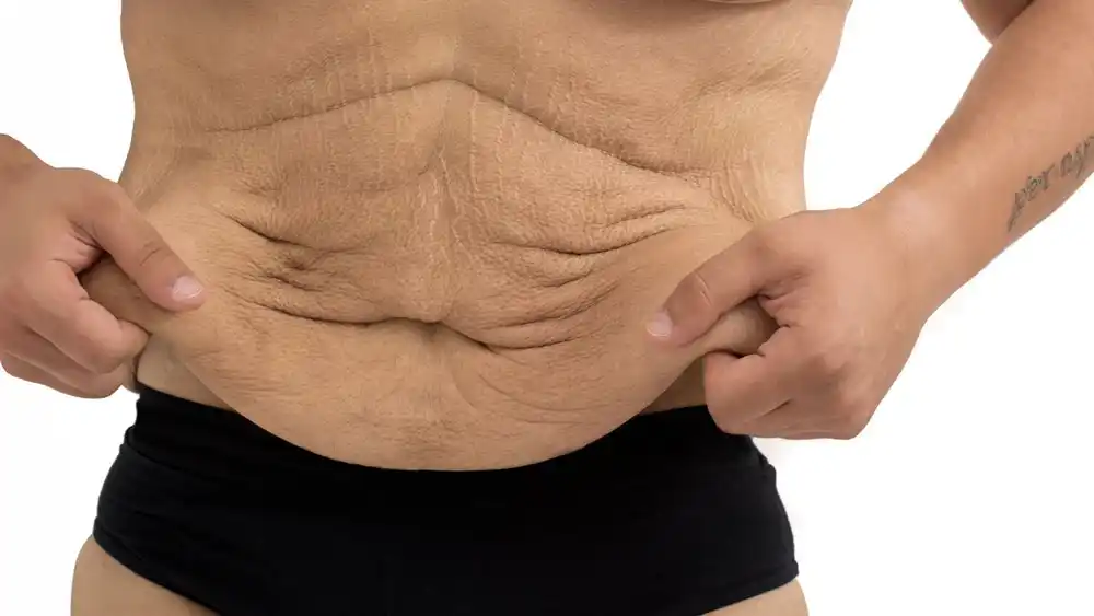 RF Microneedling for Loose Skin: How Can It Help Tighten and Reshape the Skin Sandwich?